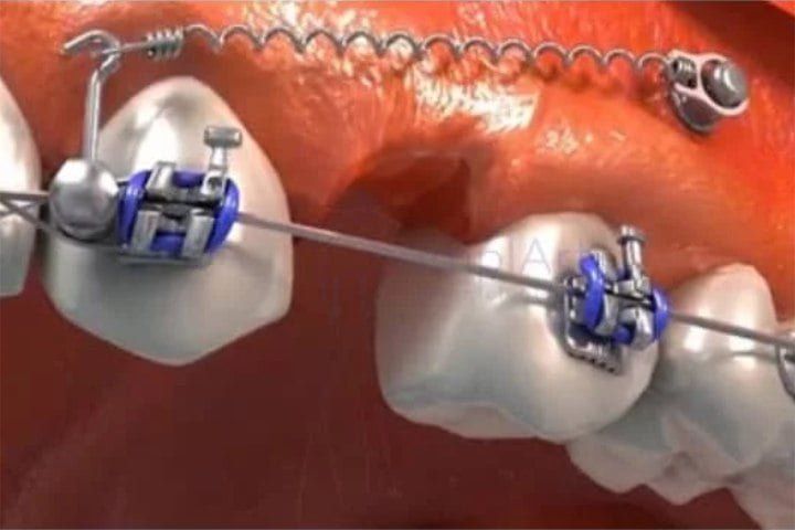 Novo mini implante dentário ortodôntico mini implante