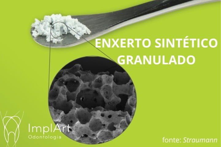 Enxerto ósseo: Pontinho branco na gengiva após fazer enxerto ósseo é um problema? enxerto ósseo granulado