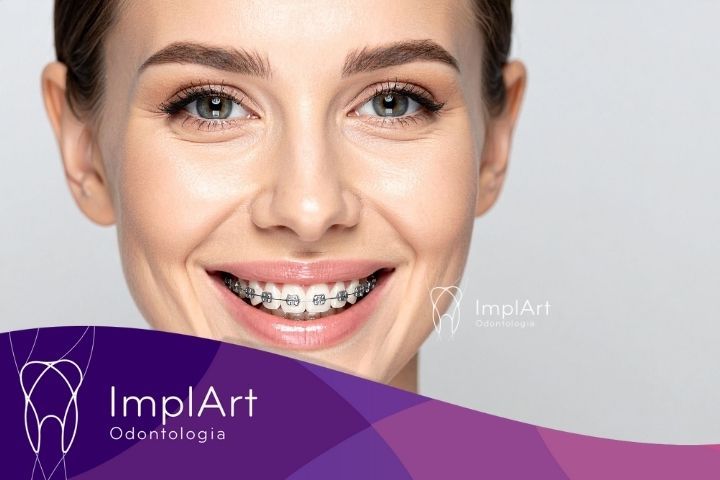 Riscos de Usar Aparelho Ortodôntico por Muito Tempo aparelho ortodontico