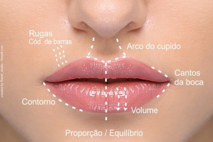 Preenchimento labial com ácido hialurônico Preenchimento labial