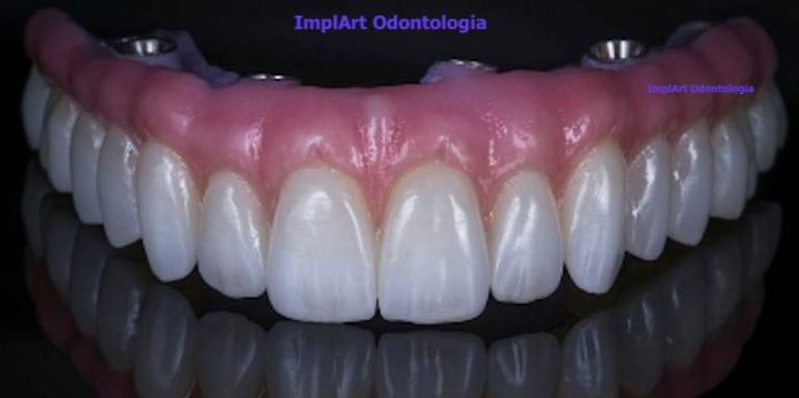 Dentaduras com dente importado ou nacional dente importado para prótese dentária