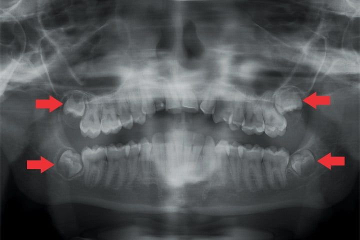 Extração dos dentes do siso dentes do siso