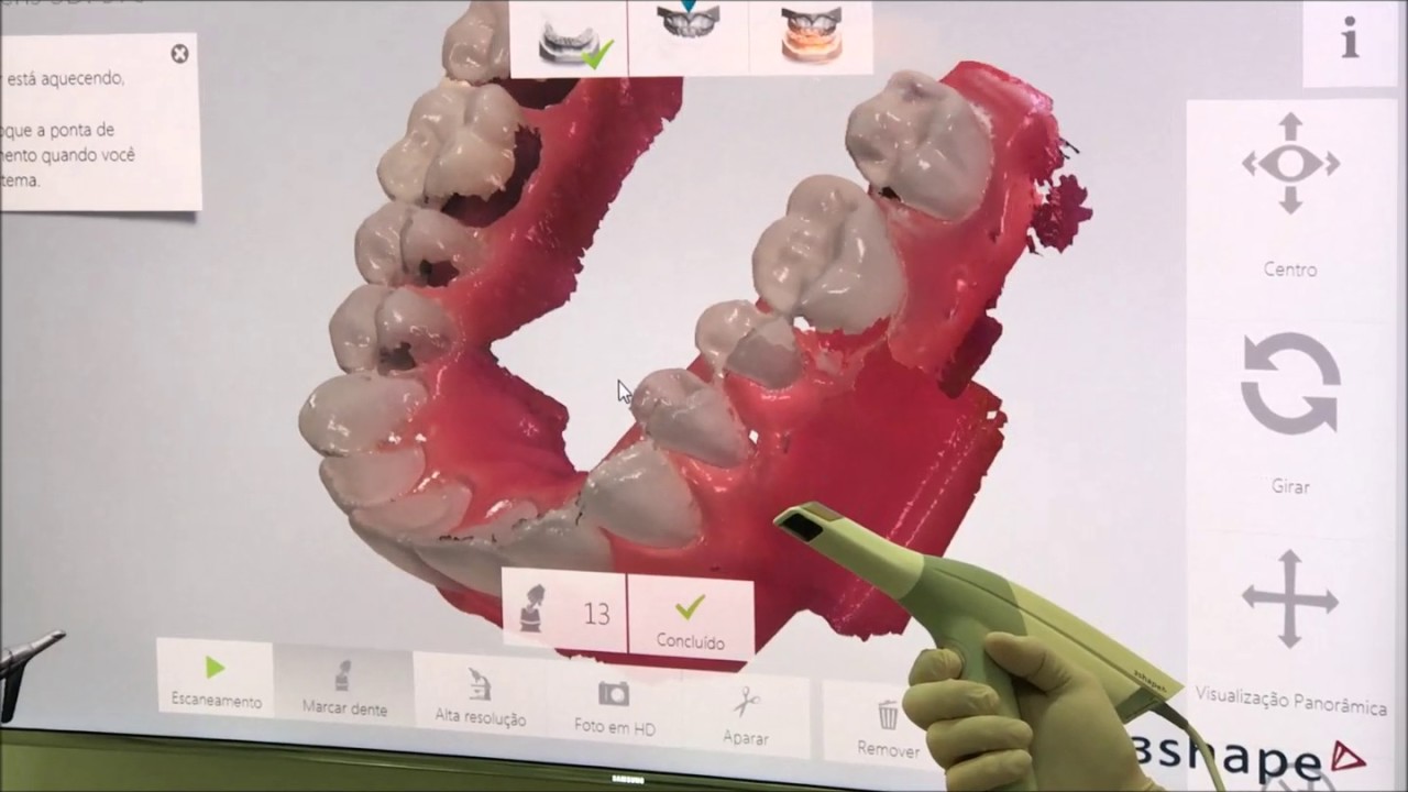 Odontologia Digital - Scanner Intraoral Trios 3 3shape na ImplArt