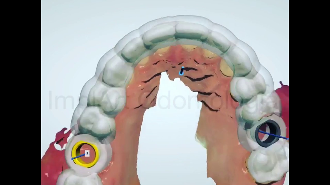 Cirurgia de Implante Dentário Guiada por Computador - Clinica ImplArt