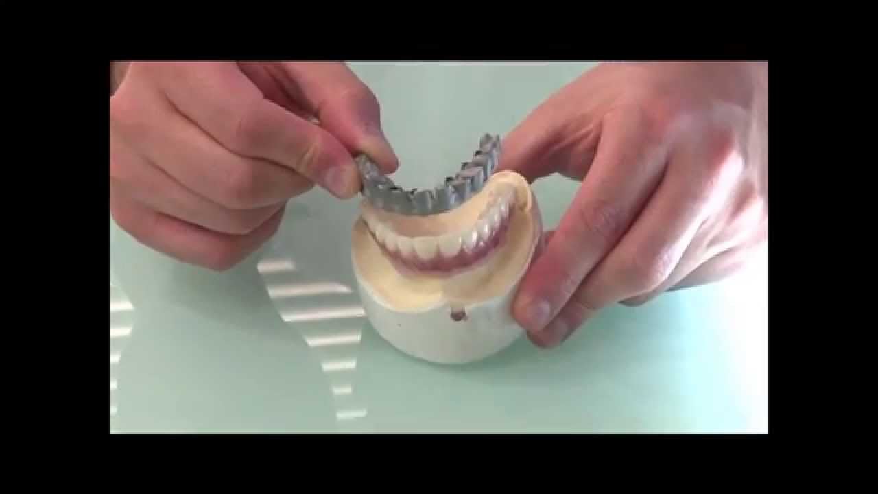 Implante Dentário de Todos os Dentes | Materiais utilizados para prótese protocolo - implante total