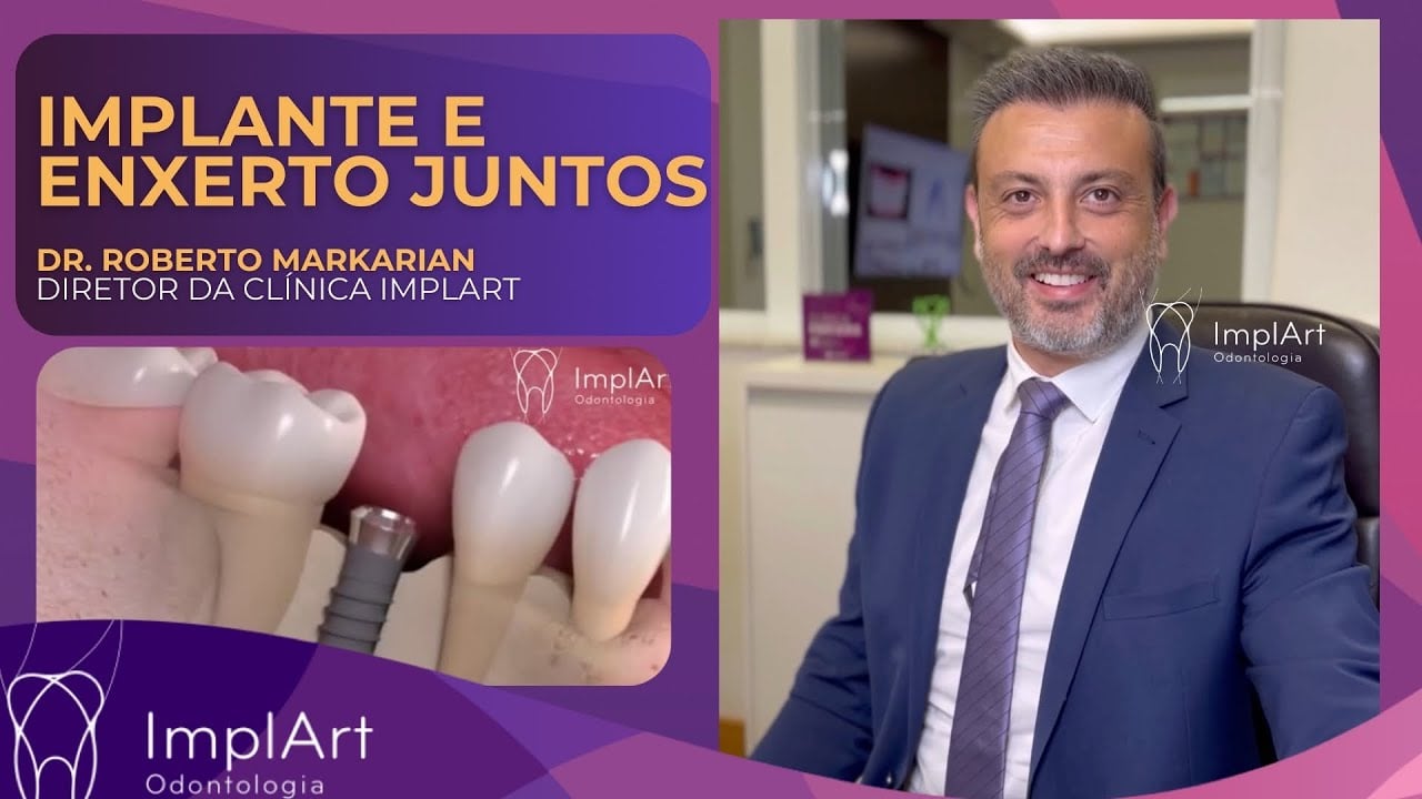 V&iacute;deo complementar da Cl&iacute;nica ImplArt sobre implantes dent&aacute;rios