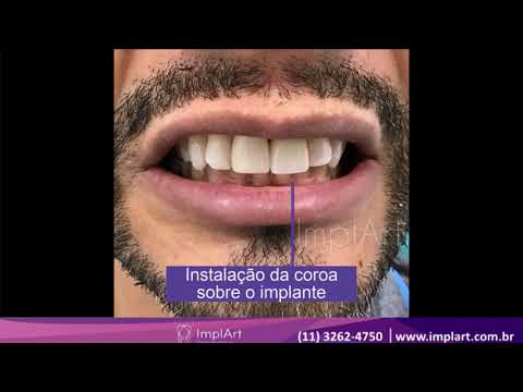 V&iacute;deo da Cl&iacute;nica ImplArt sobre implante dent&aacute;rio