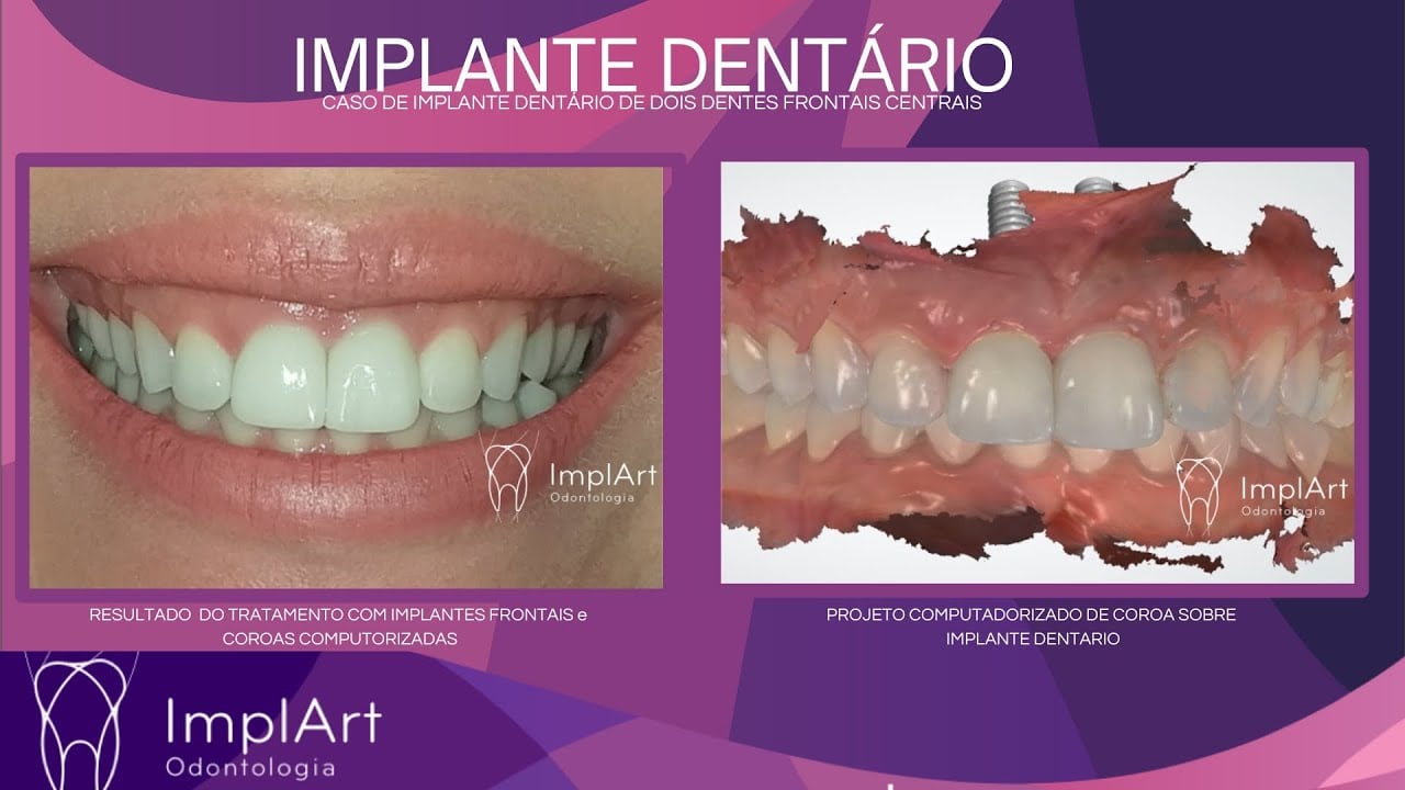 Segundo v&iacute;deo da Cl&iacute;nica ImplArt sobre implantes dent&aacute;rios