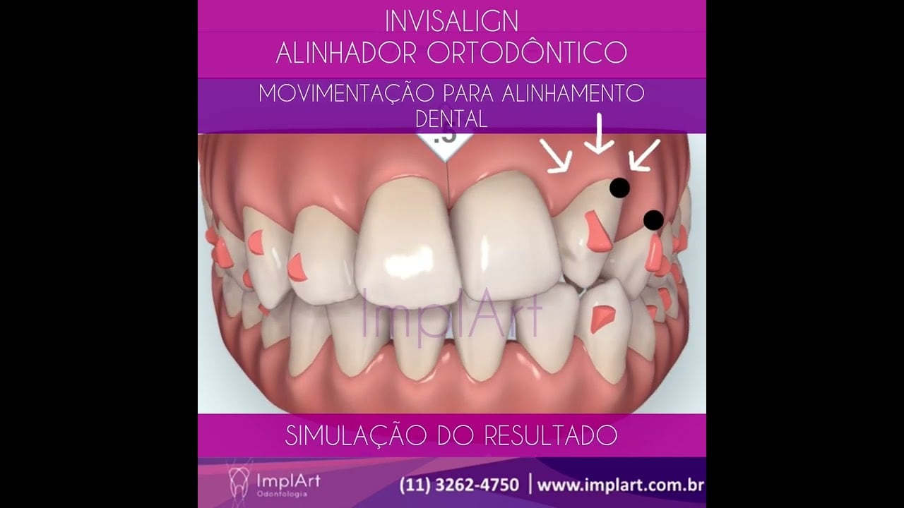 APARELHO INVISALIGN VEJA A MOVIMENTAÇÃO PLANEJADA DOS DENTES