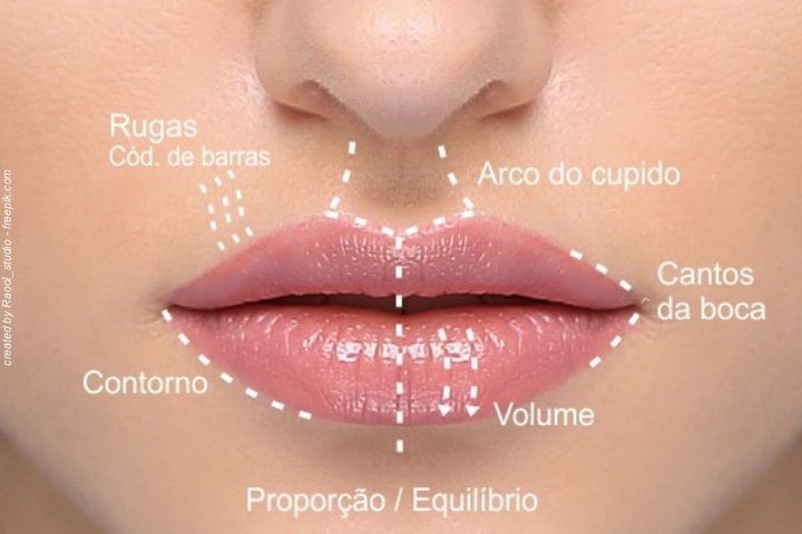 Preenchimento labial com ácido hialurônico Preenchimento labial