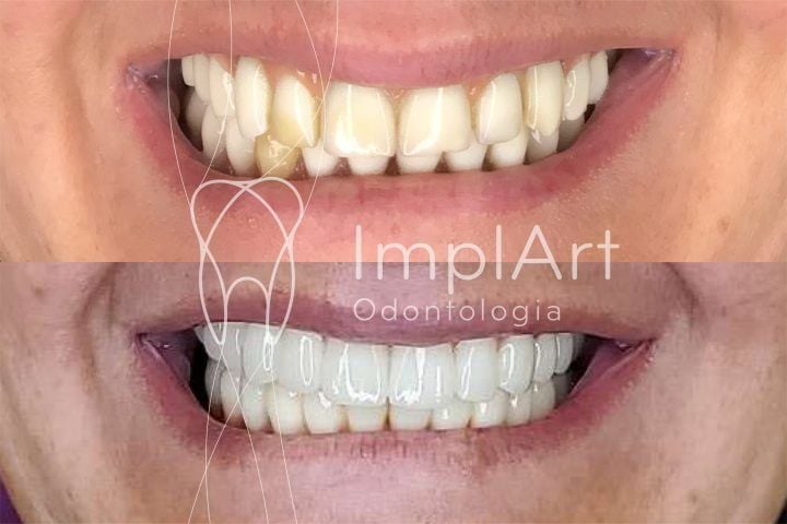 implantes dentario antes e depois