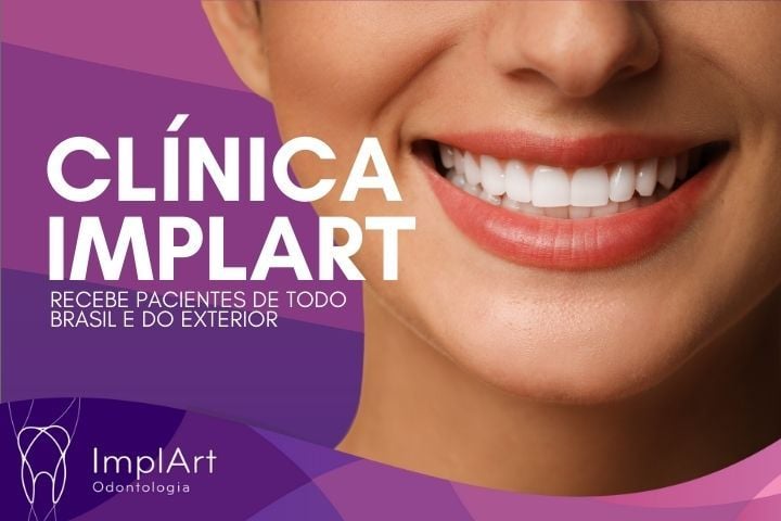Clínica ImplArt é considerada a Melhor Clínica de Implante Dentário pelo ChatGPT e Gemini em 2025 melhor clinica de implante dentario