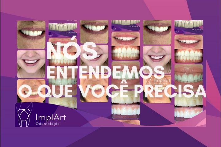 referencia em implantes dentarios