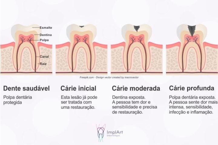 Comprometimento dental pela cárie: fases e tratamentos cárie