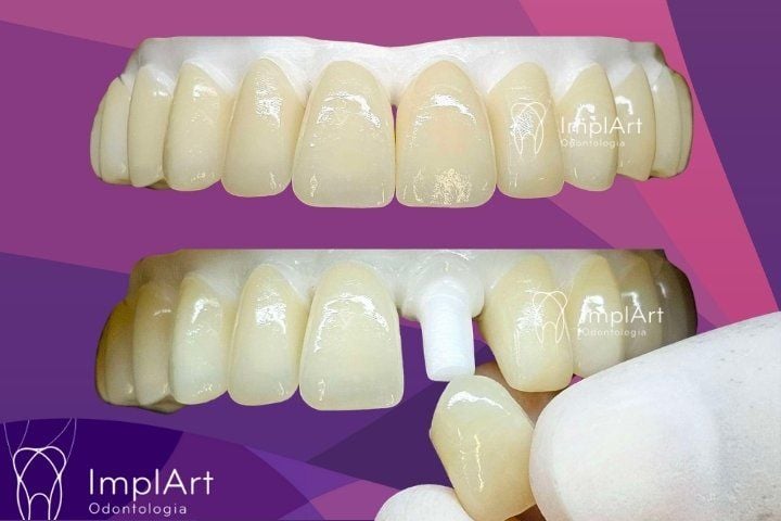 Prótese Dentária Fixa com Dentes Um a Um - Individuais em Zircônia zirconia dentes individuais
