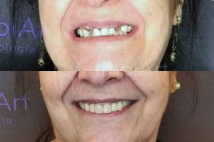 como é feito um implante dentário 48