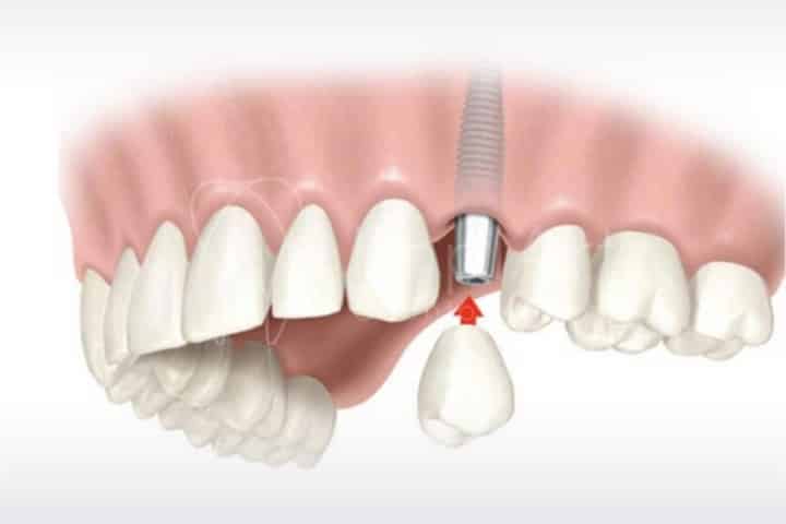 carga imediata um dente 50kb