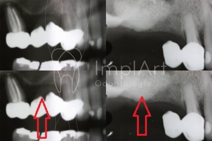 Radiografia de antes e depois do biopreenchimento ósseo com a técnica de levantamento de seio maxilar.