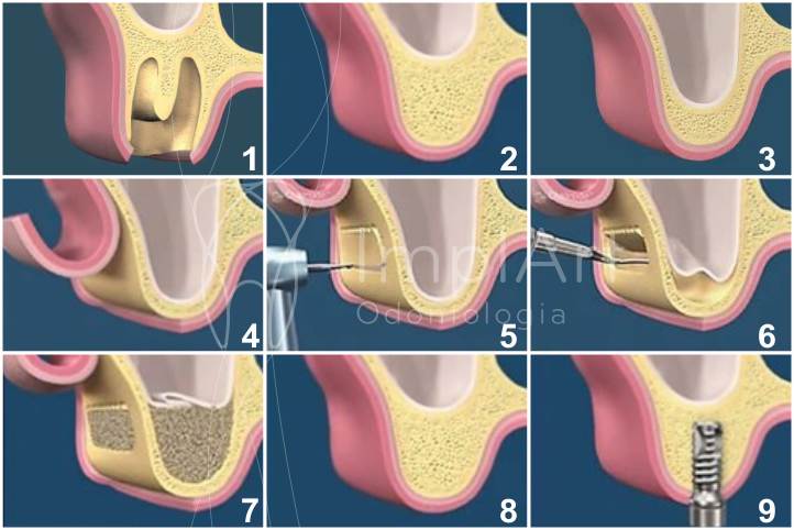 enxerto osseo dentario para implantes dentarios levantamento de seio maxilar