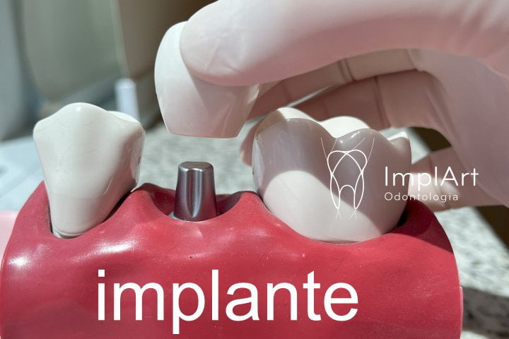 implante dentario como e a cirurgia e o pos peratorio de implantes 