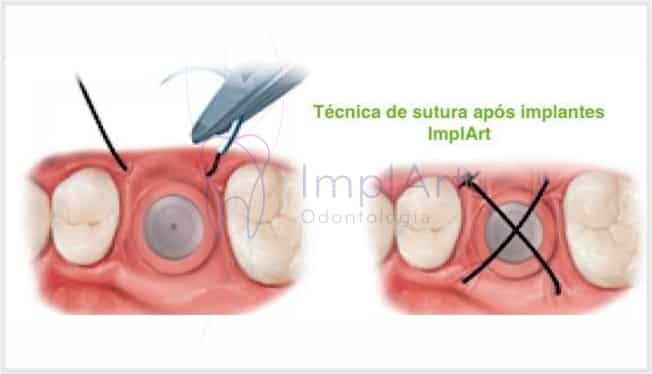 Pré e pós operatório de implantes dentários