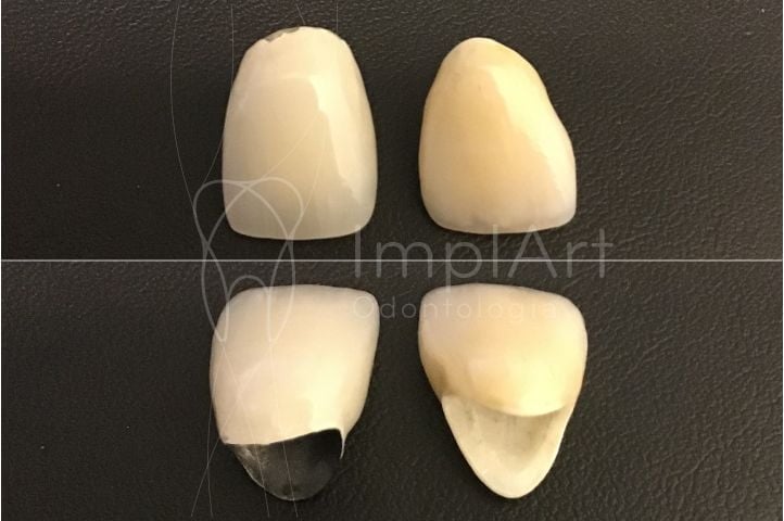 comparação da coroa metalo-ceramica ( que tem metais) com a coroa zirconia pura sem metais