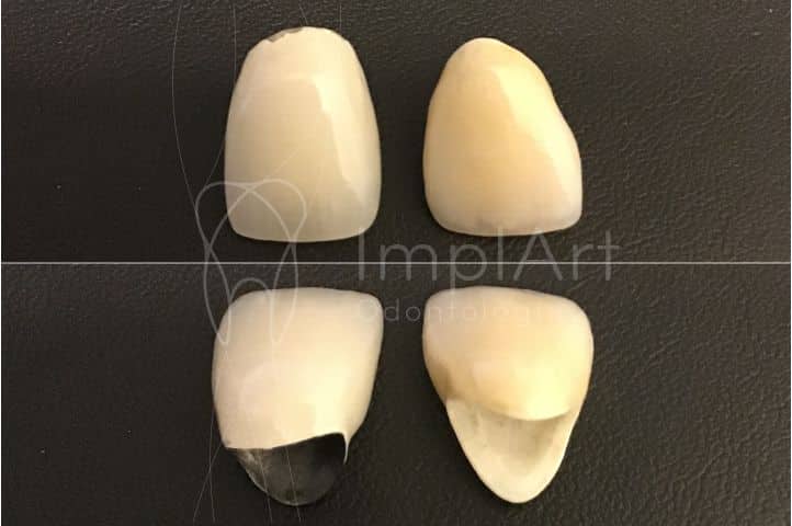 coroa metaloceramica x coroa de zirconia