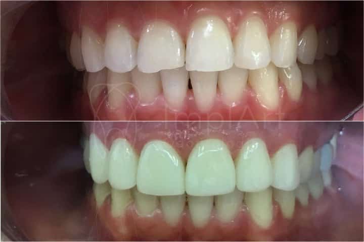 Lente contato dental antes e depois 47