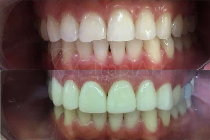 ALINHADOR ORTODÔNTICO E LENTE DE CONTATO DENTAL