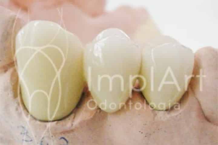 ponte dentaria metaloceramica 3 dentes