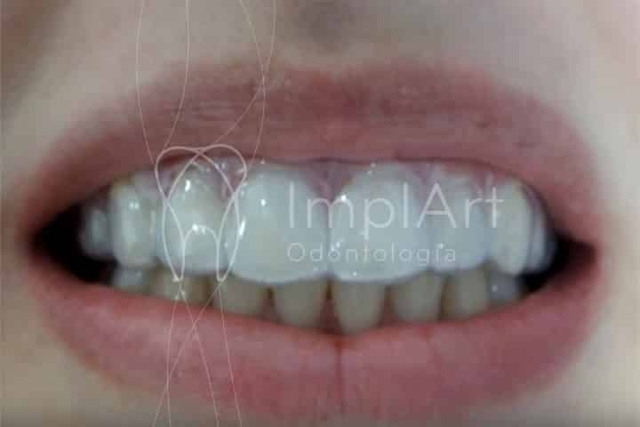 clareamento dental caseiro moldeira gel 49kb