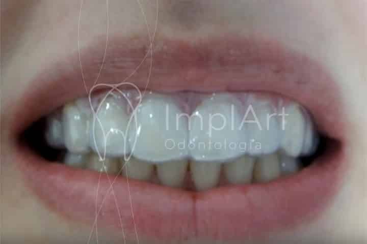 clareamento dental em casa com gel