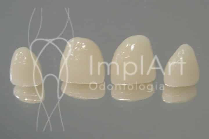 coroa cimentada zirconia 50kb