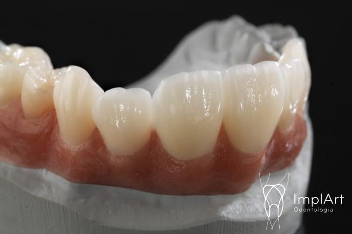 coroas de zirconia multlayer