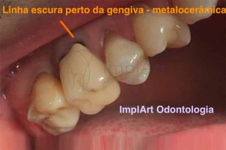 coroa metaloceramica metal aparecendo 49kb