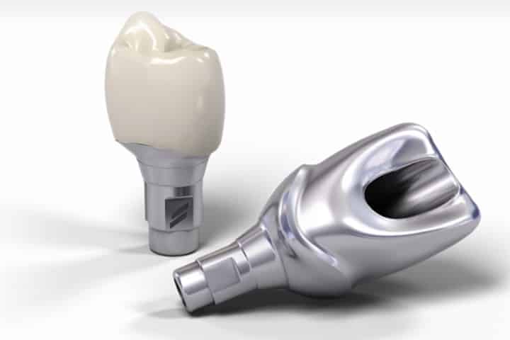 Tipos de coroas dentárias: conheça os 5 principais modelos 11 implante pilar coroa 49kb