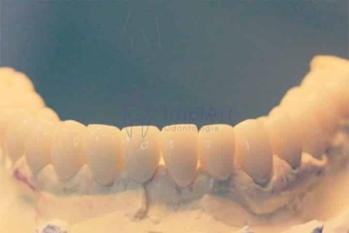 implante total dentes individualizados 50kb