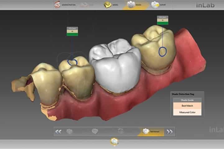 projetanto coroa cerec 50kb