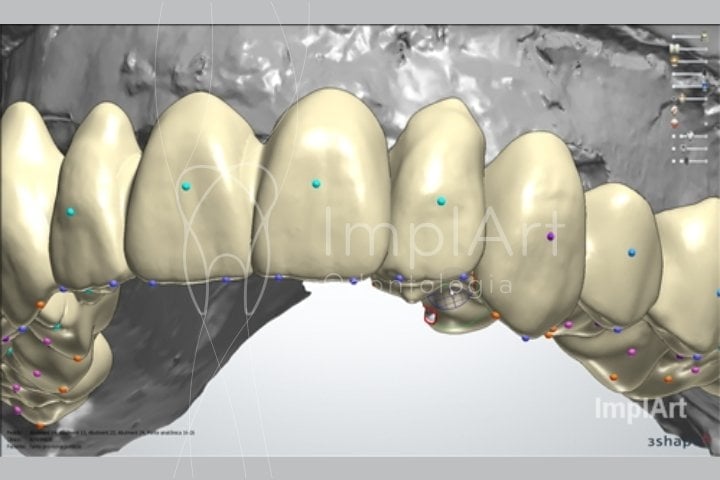 Planejamento computadorizado de próteses metal free, prótese dentária em computador