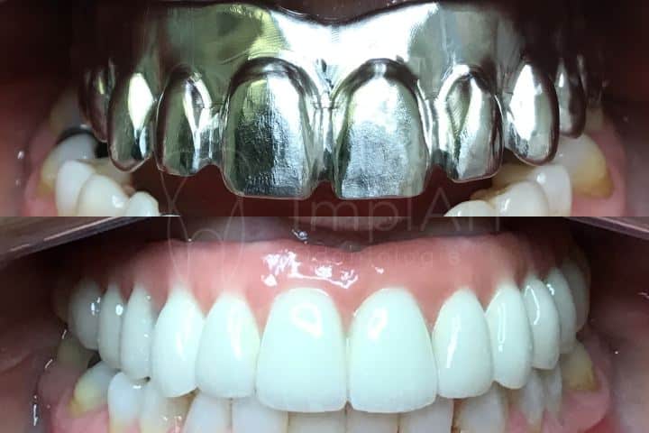protese dentaria metaloceramica de arcada completa superior