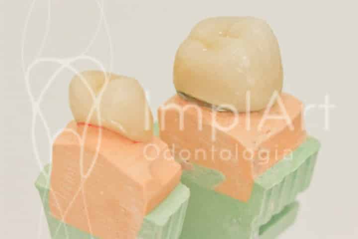 coroa de zirconia x coroa metaloceramica