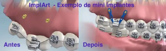 Antes e depois de implante dentario mini