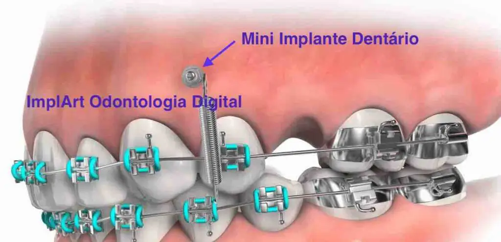 implante dentario mini 