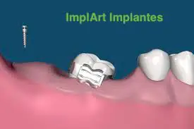 mini implante dentario