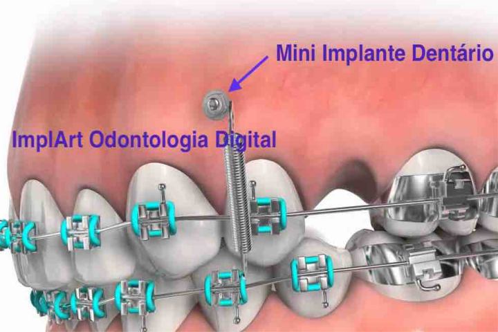 mini implante ortodontico 50kb