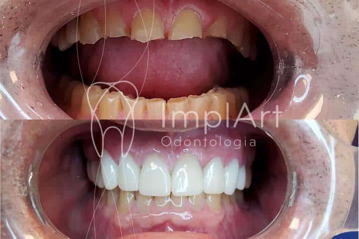 antes e depois do tratamento de bruxismo feito na implart