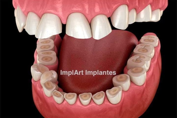 Imploodonto - Bruxismo é uma desordem funcional que se caracteriza pelo  ranger ou apertar dos dentes durante o sono. Essa pressão pode provocar  desgaste e amolecimento dos dentes. Nos casos mais graves