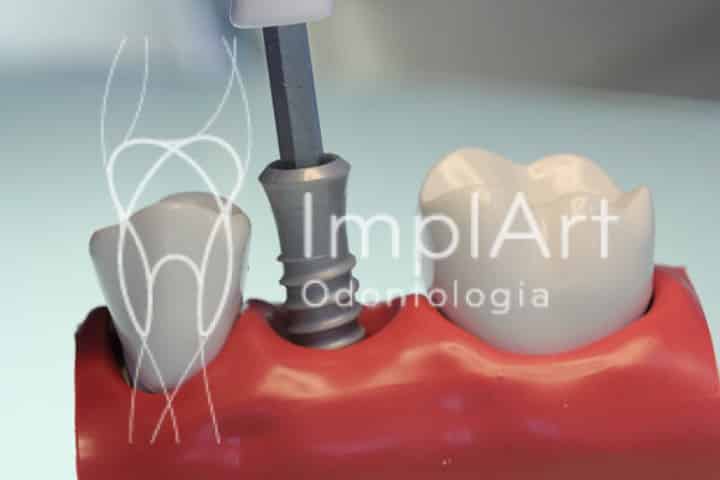 pós operatório de cirurgia de implantes