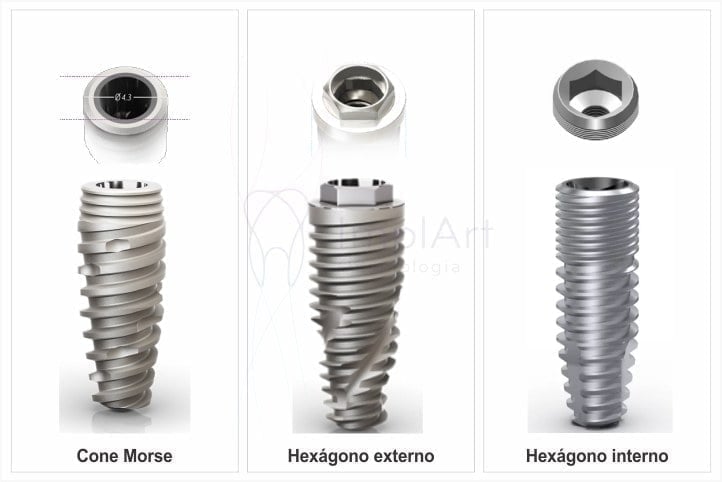 conexões de próteses sobre implantes, Tipos de encaixe implante dentário e coroa