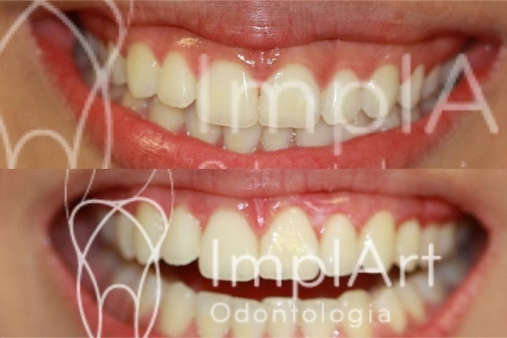 gengivectomia antes e depois 49kb